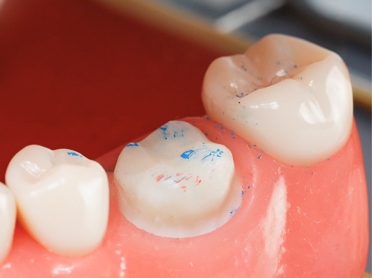 Prepared tooth with PrepCheck coating marks showing areas that need more reduction