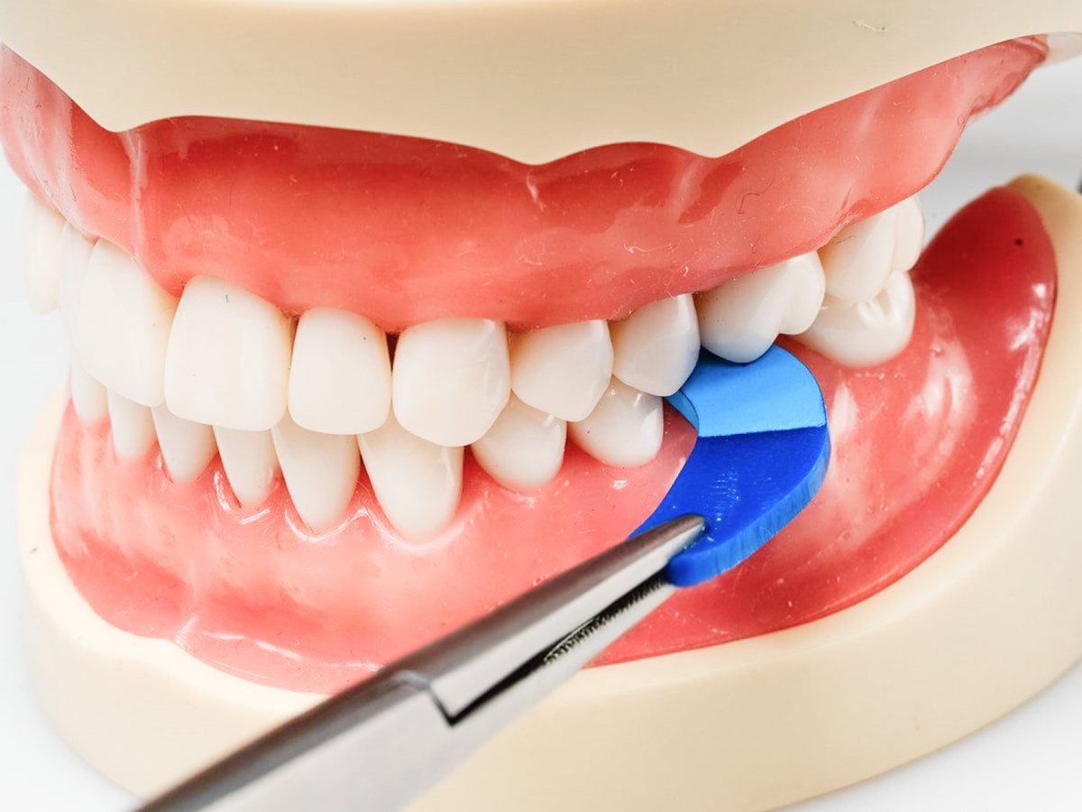Blue PrepCheck prep-marking tool positioned on a tooth in a dental typodont