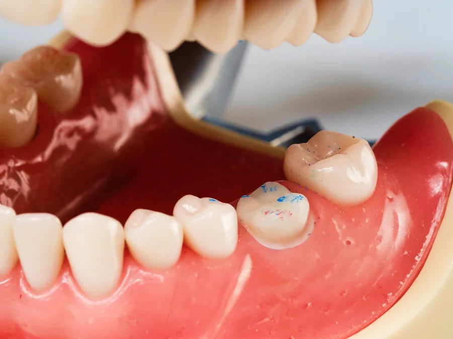 PrepCheck prep-marking tool placed on a prepared posterior tooth in a dental typodont