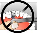 Dental Wedge Incorrectly Placed
