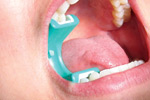 LogiBloc in Patient's Mouth